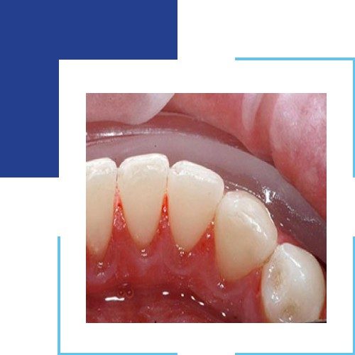 4 Types Of Dental Cleanings